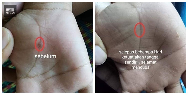 cara hilangkan ketuat dengan mudah dan cepat